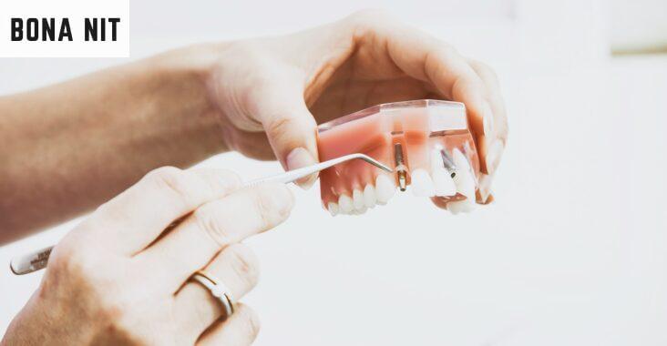 Beneficios de los implantes dentales