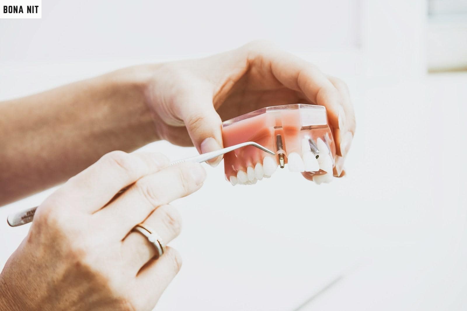 Beneficios de los implantes dentales