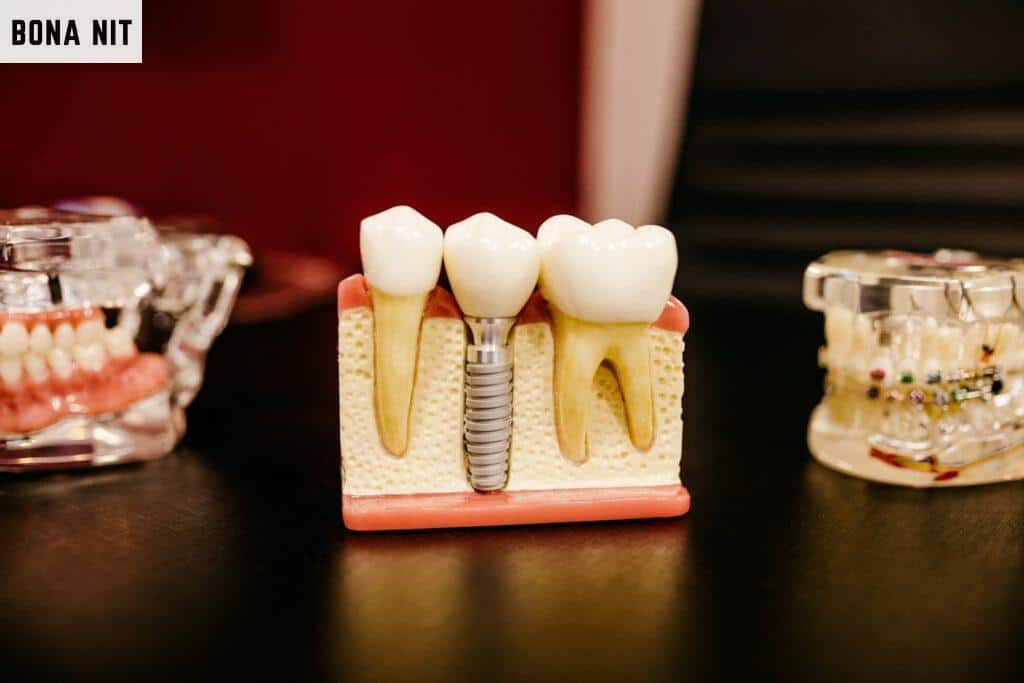 Beneficios de los implantes